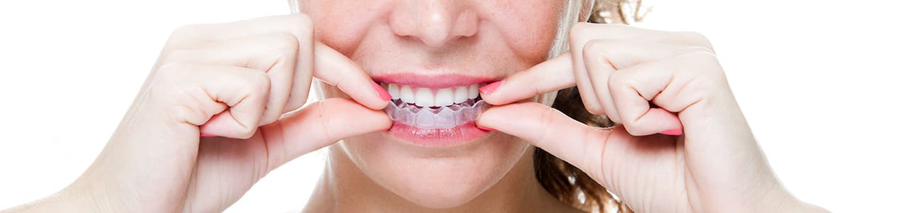 Invisalign Provider in Northwest (NW) Calgary